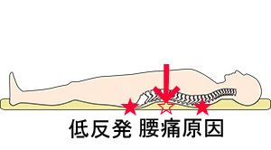 低反発トゥルースリーパー腰痛理由と治し方北海道、札幌，